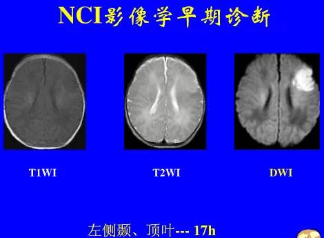 影像PPT - 【PPT】新生儿头部核磁共振成像-31