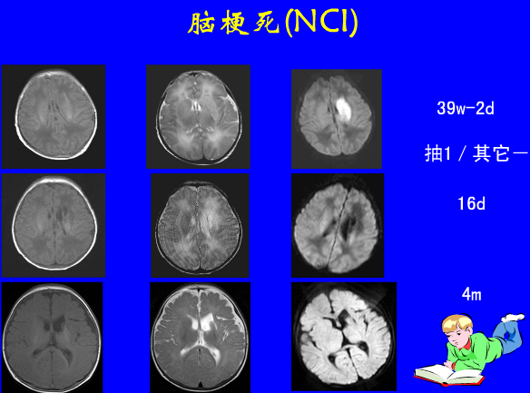 影像PPT - 【PPT】新生儿头部核磁共振成像-33