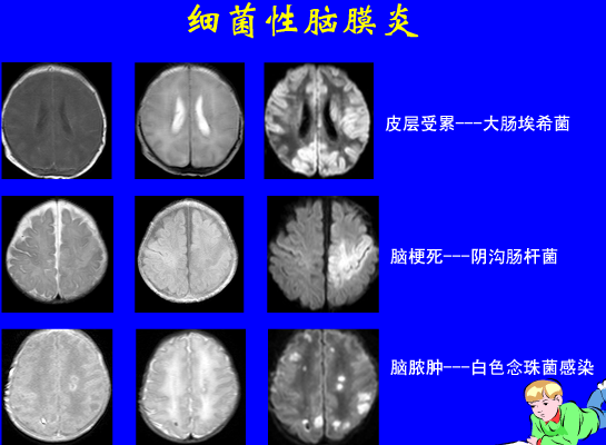 影像PPT - 【PPT】新生儿头部核磁共振成像-37