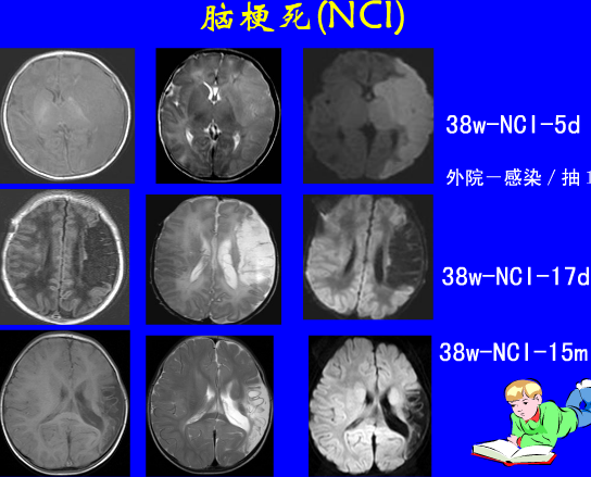 影像PPT - 【PPT】新生儿头部核磁共振成像-32