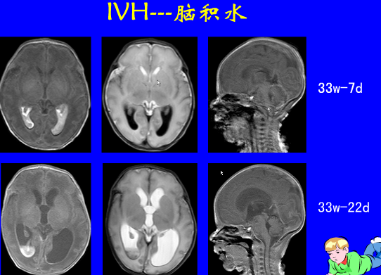 影像PPT - 【PPT】新生儿头部核磁共振成像-39