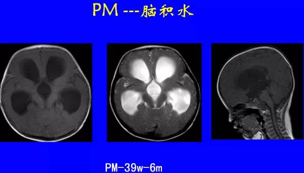 影像PPT - 【PPT】新生儿头部核磁共振成像-41