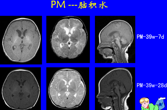 影像PPT - 【PPT】新生儿头部核磁共振成像-40