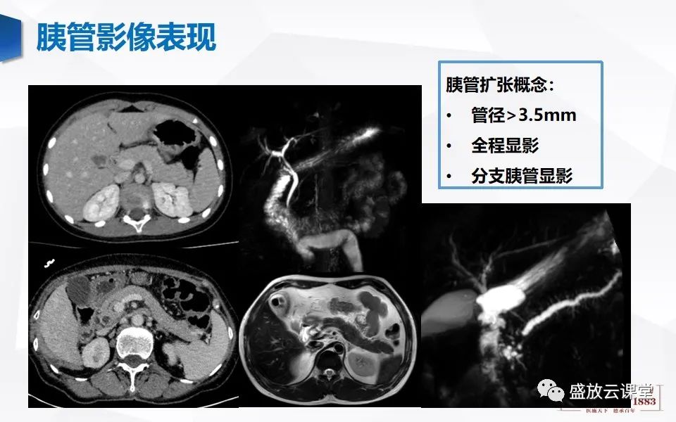 影像PPT - 【PPT】胰管增宽影像表现及意义-4