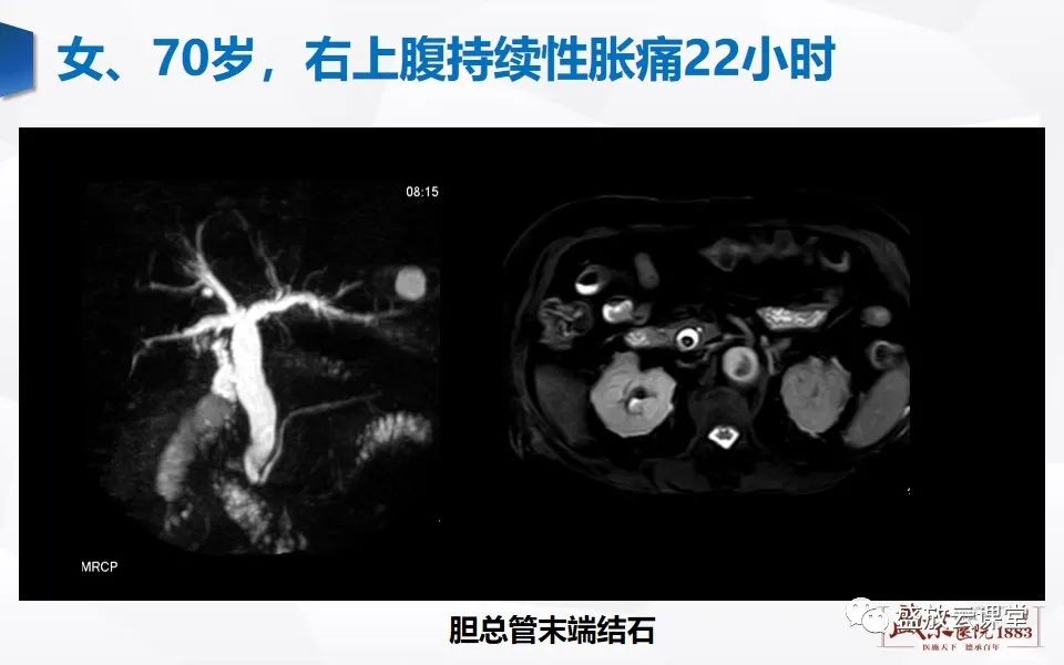 影像PPT - 【PPT】胰管增宽影像表现及意义-10