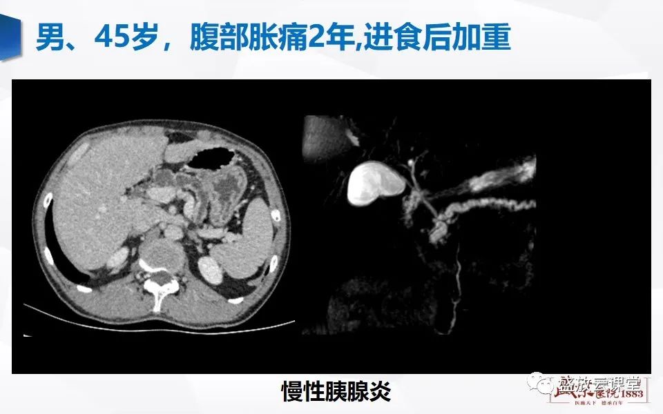 影像PPT - 【PPT】胰管增宽影像表现及意义-9