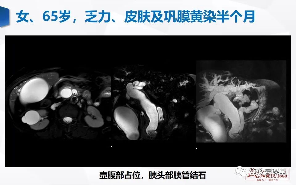 影像PPT - 【PPT】胰管增宽影像表现及意义-11