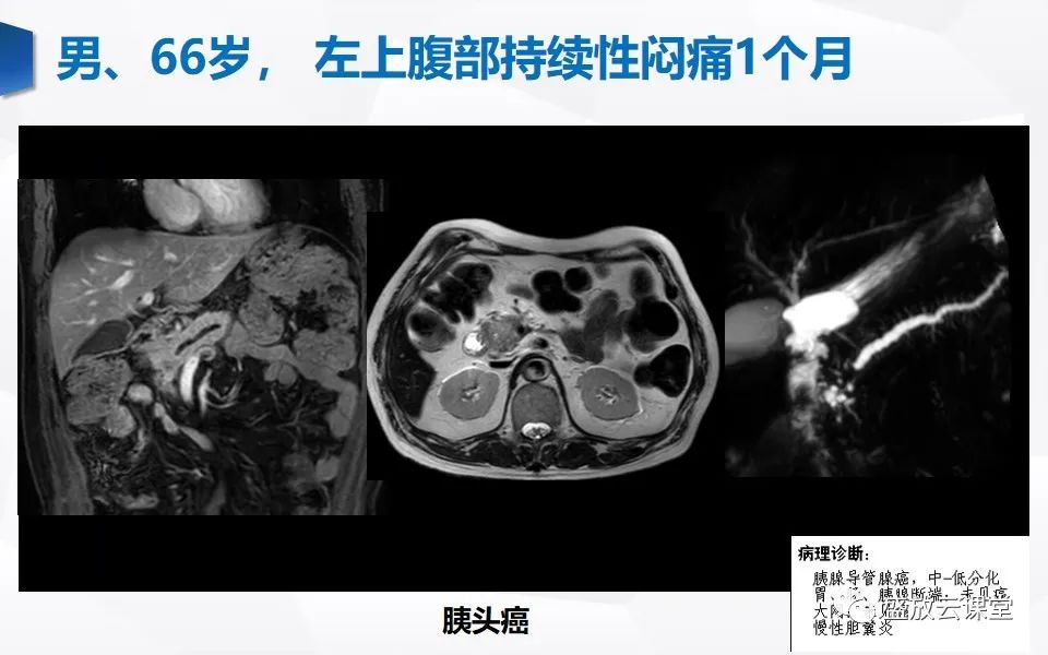 影像PPT - 【PPT】胰管增宽影像表现及意义-12