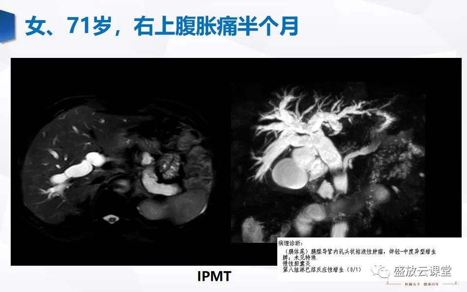影像PPT - 【PPT】胰管增宽影像表现及意义-15