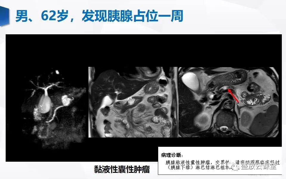 影像PPT - 【PPT】胰管增宽影像表现及意义-16