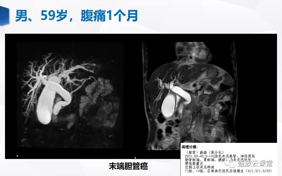 影像PPT - 【PPT】胰管增宽影像表现及意义-18