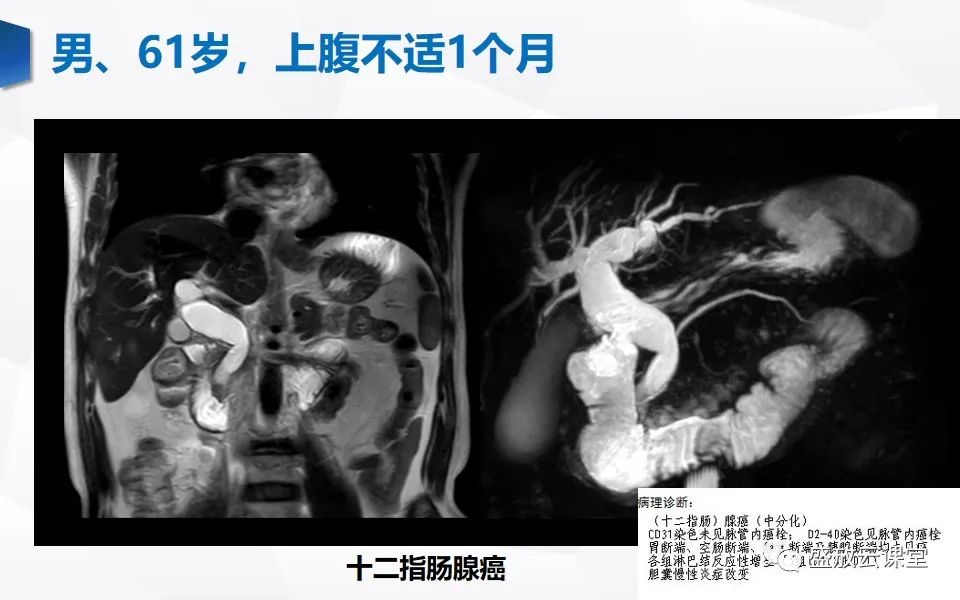 影像PPT - 【PPT】胰管增宽影像表现及意义-19