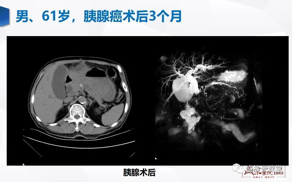 影像PPT - 【PPT】胰管增宽影像表现及意义-20
