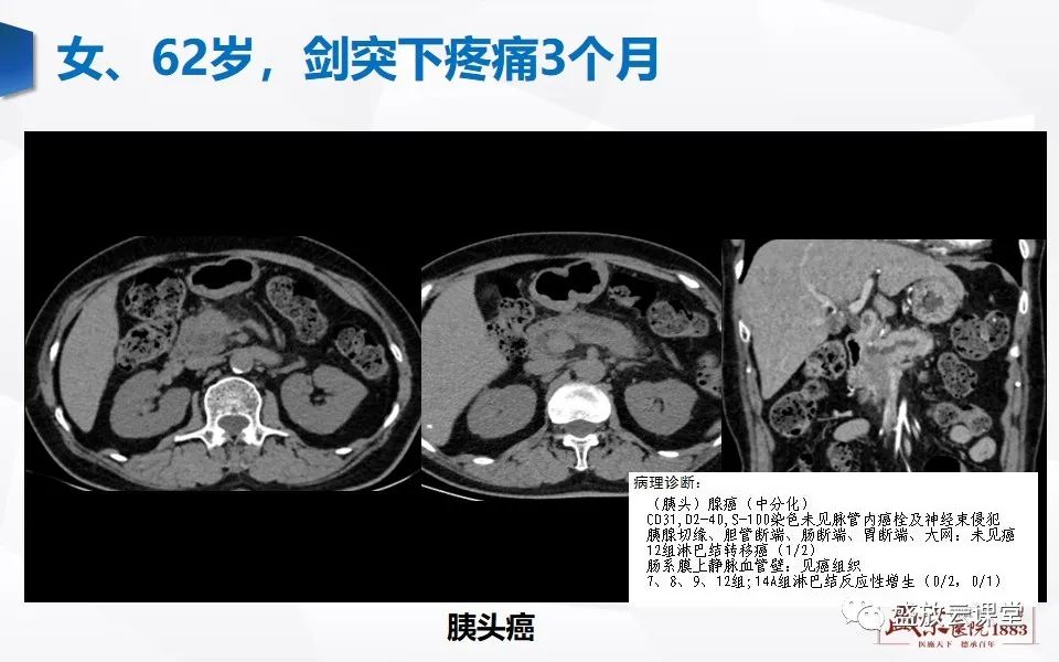 影像PPT - 【PPT】胰管增宽影像表现及意义-13