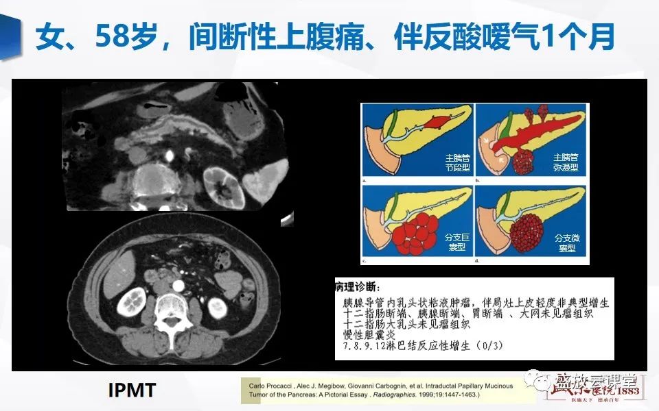 影像PPT - 【PPT】胰管增宽影像表现及意义-14