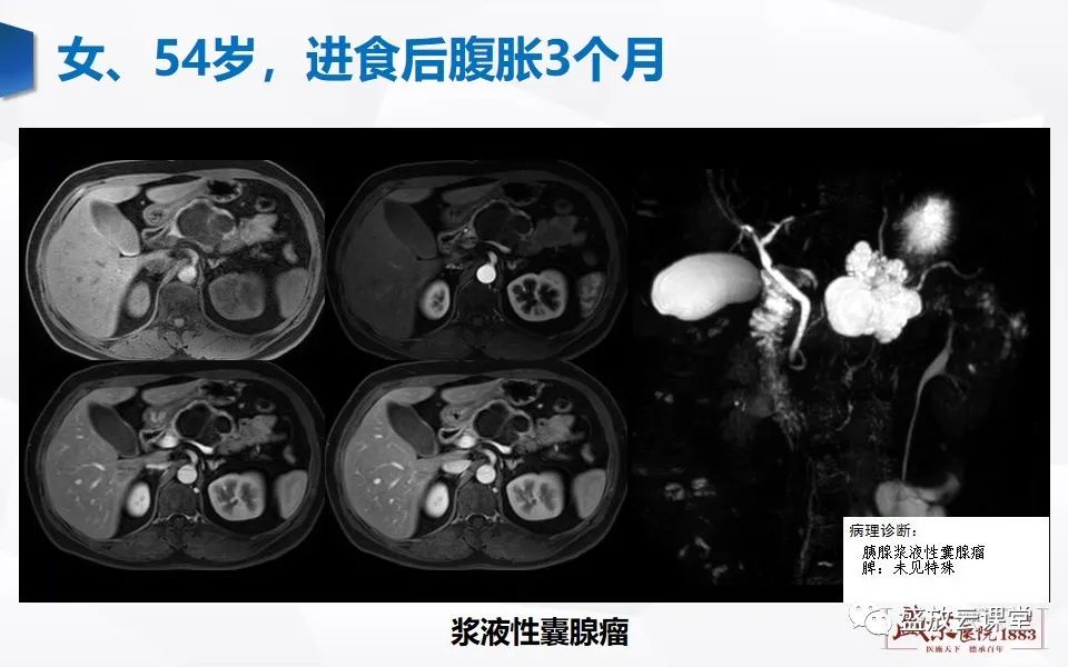 影像PPT - 【PPT】胰管增宽影像表现及意义-17