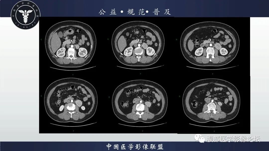 影像PPT - 【病例】腹膜后Castleman病1例CT影像诊断-4