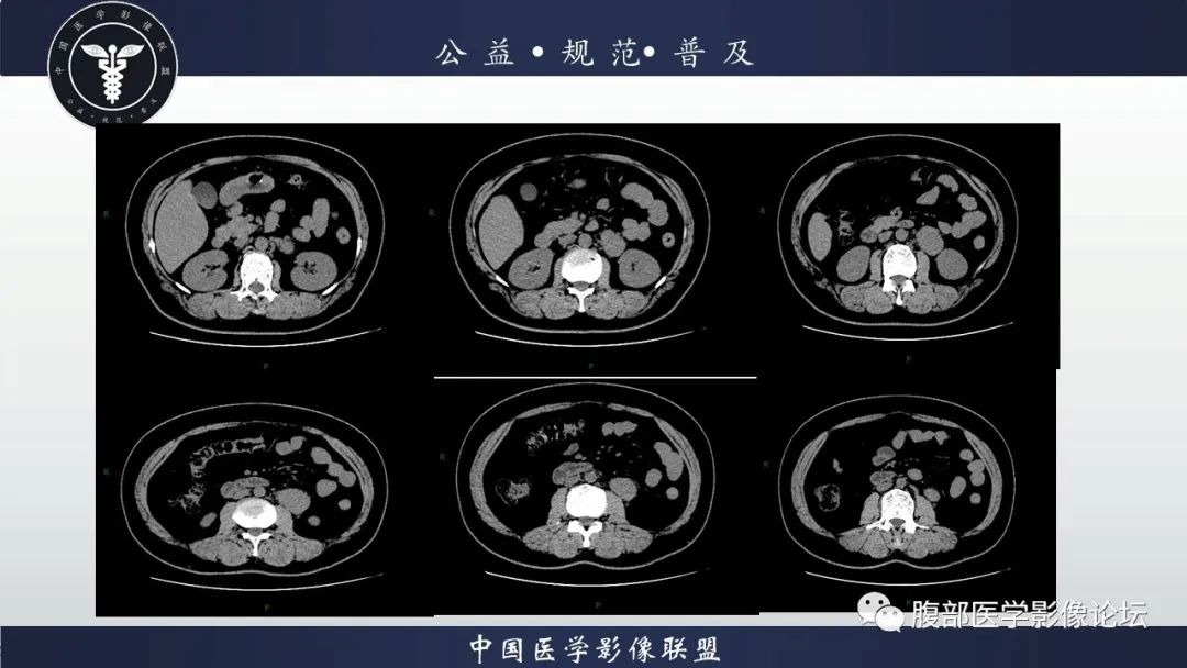 影像PPT - 【病例】腹膜后Castleman病1例CT影像诊断-3