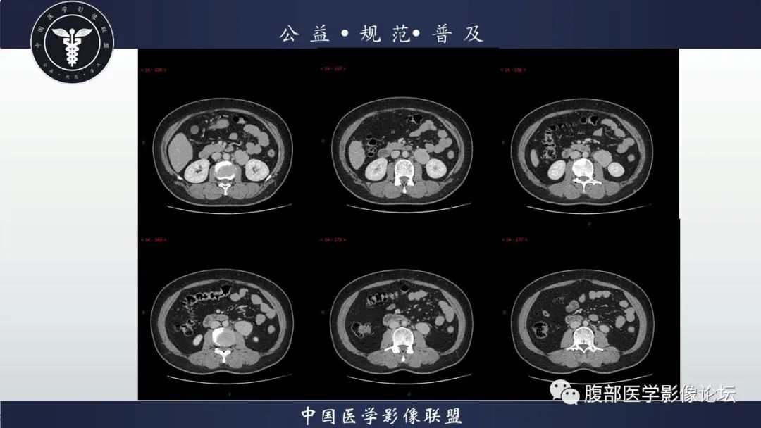 影像PPT - 【病例】腹膜后Castleman病1例CT影像诊断-6