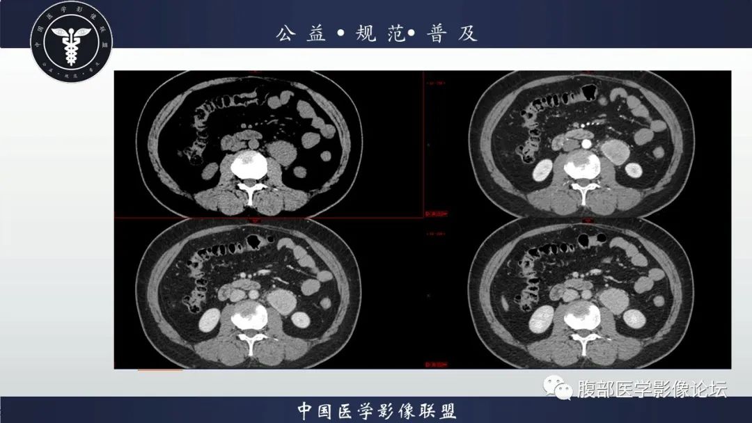 影像PPT - 【病例】腹膜后Castleman病1例CT影像诊断-9