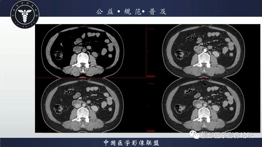 影像PPT - 【病例】腹膜后Castleman病1例CT影像诊断-10
