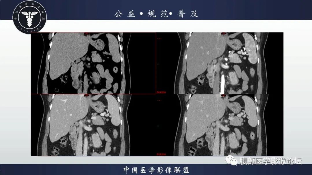 影像PPT - 【病例】腹膜后Castleman病1例CT影像诊断-11