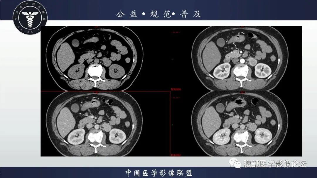 影像PPT - 【病例】腹膜后Castleman病1例CT影像诊断-7
