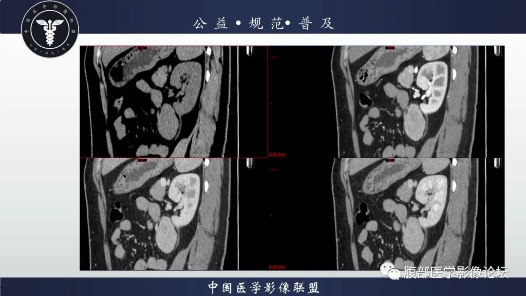 影像PPT - 【病例】腹膜后Castleman病1例CT影像诊断-13