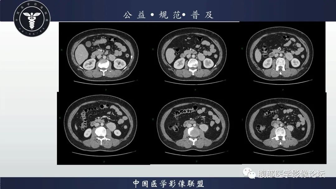 影像PPT - 【病例】腹膜后Castleman病1例CT影像诊断-5