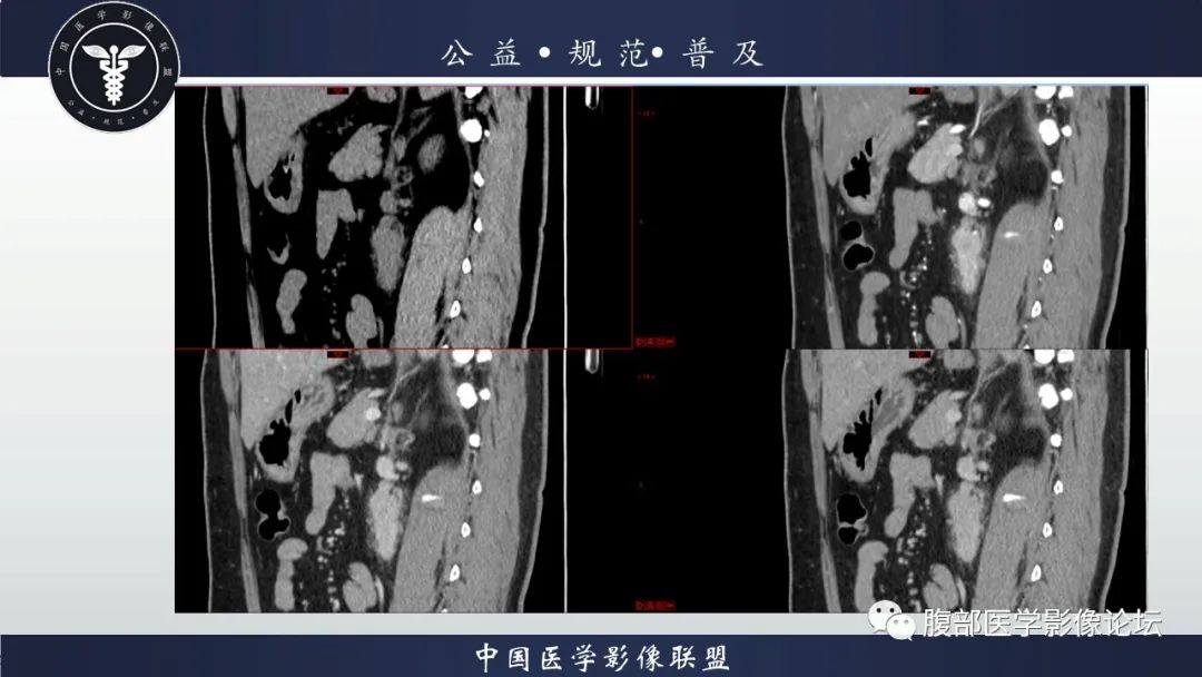 影像PPT - 【病例】腹膜后Castleman病1例CT影像诊断-15