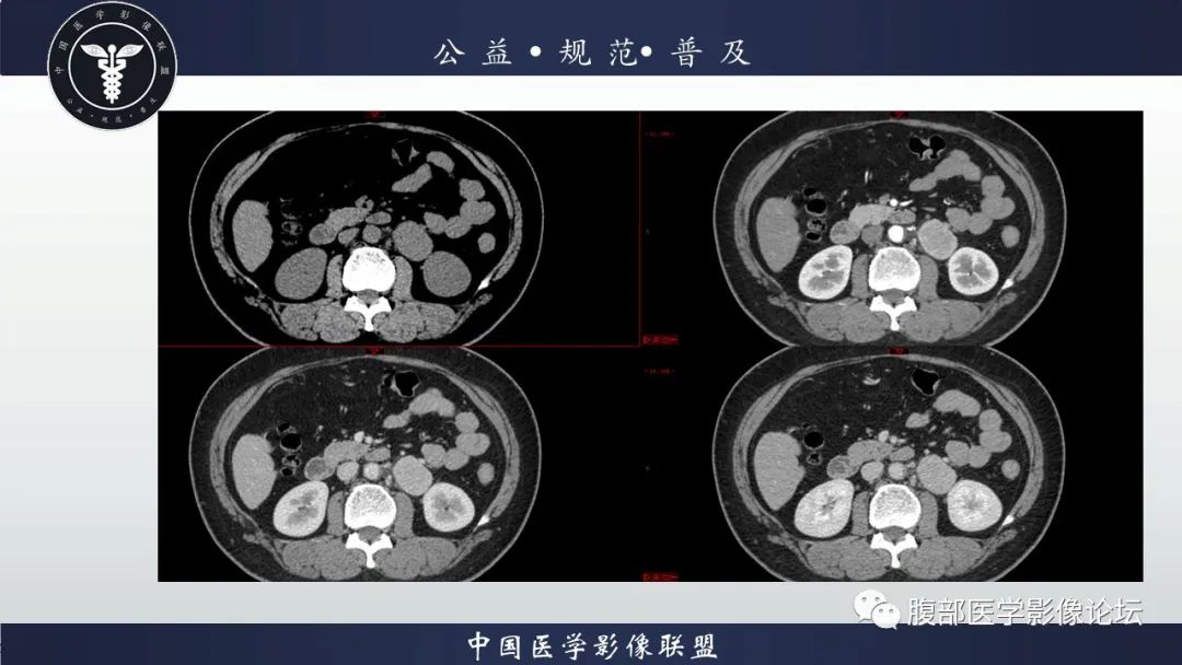 影像PPT - 【病例】腹膜后Castleman病1例CT影像诊断-8