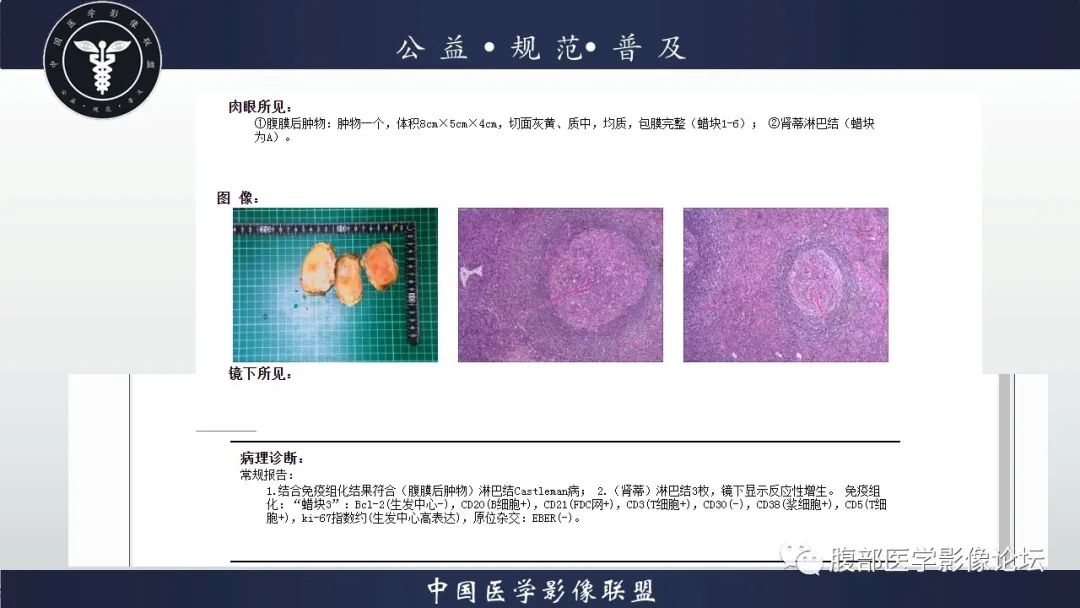 影像PPT - 【病例】腹膜后Castleman病1例CT影像诊断-17
