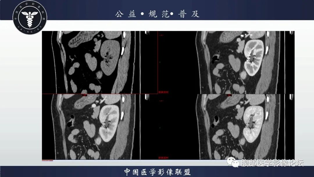 影像PPT - 【病例】腹膜后Castleman病1例CT影像诊断-12