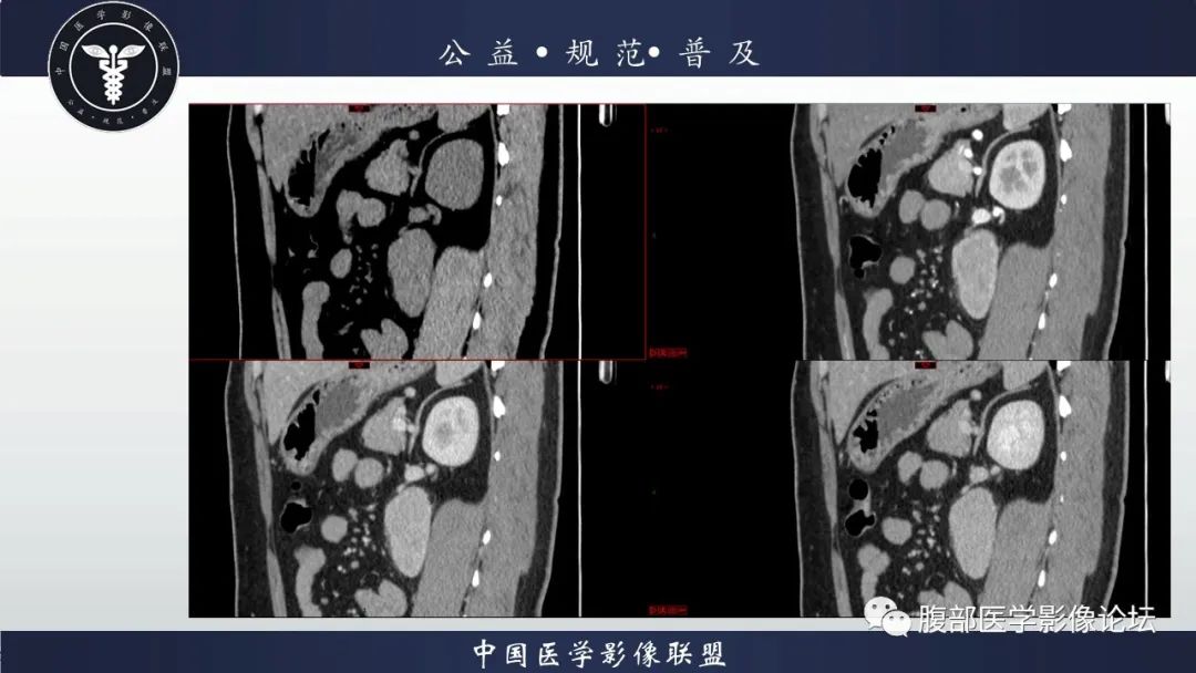 影像PPT - 【病例】腹膜后Castleman病1例CT影像诊断-14