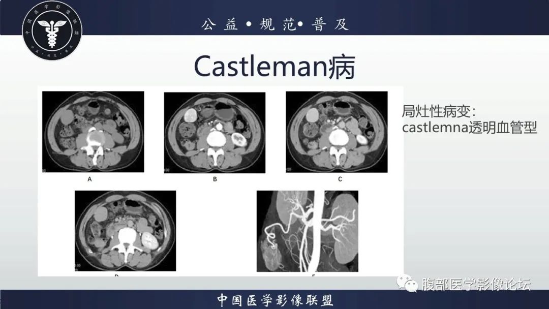 影像PPT - 【病例】腹膜后Castleman病1例CT影像诊断-24