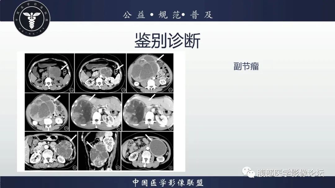 影像PPT - 【病例】腹膜后Castleman病1例CT影像诊断-27