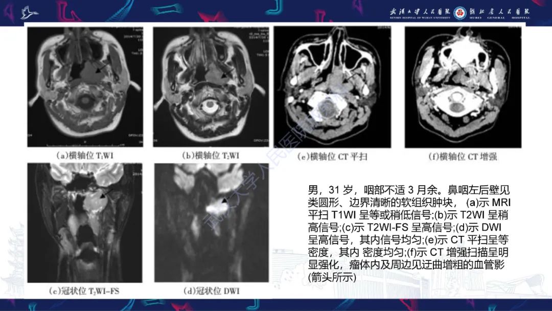 影像PPT - 【PPT】髓外浆细胞瘤影像诊断-10