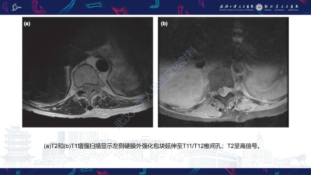 影像PPT - 【PPT】髓外浆细胞瘤影像诊断-15