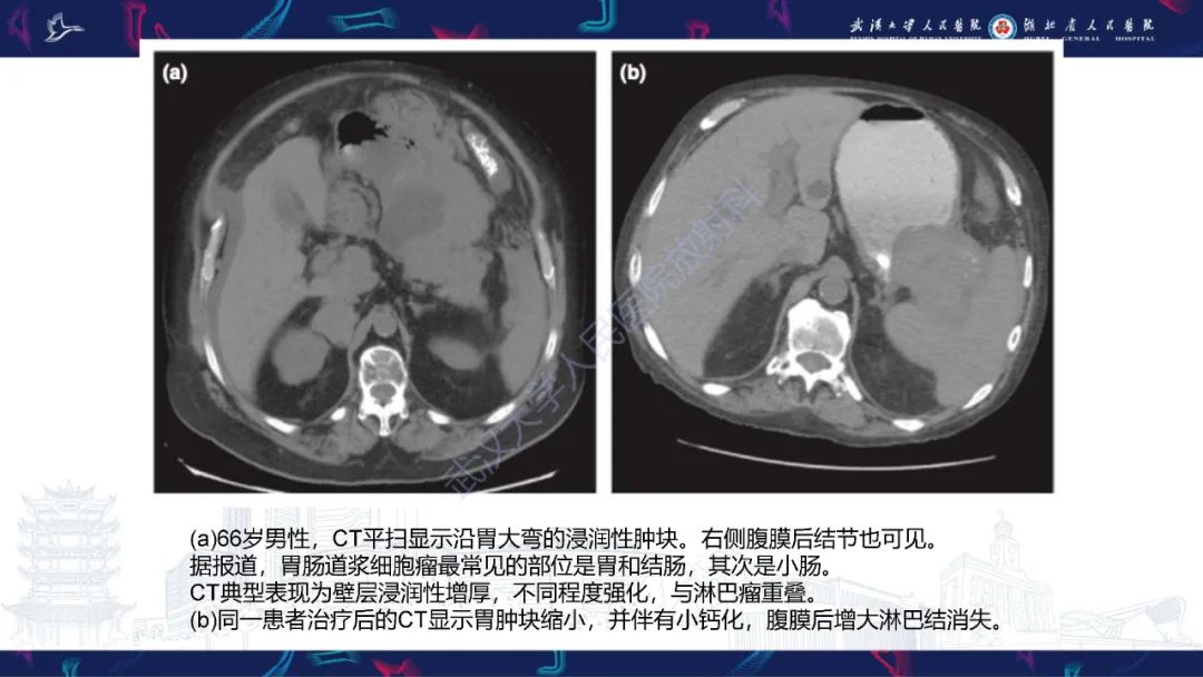 影像PPT - 【PPT】髓外浆细胞瘤影像诊断-11