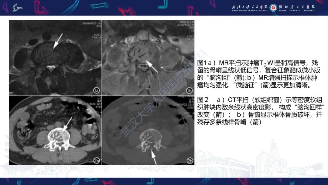 影像PPT - 【PPT】髓外浆细胞瘤影像诊断-17