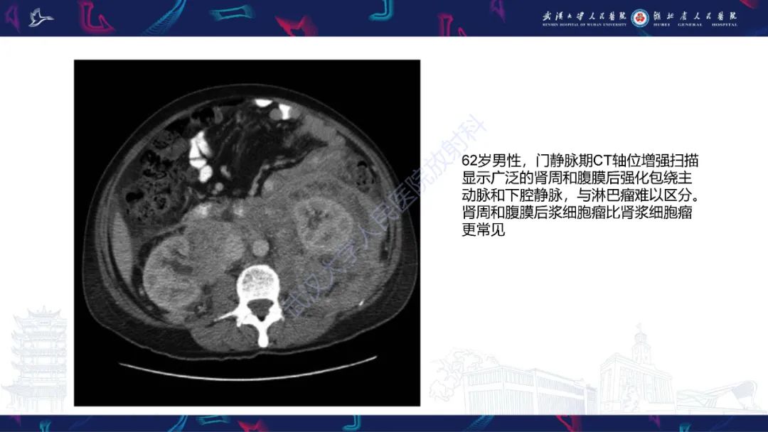影像PPT - 【PPT】髓外浆细胞瘤影像诊断-12