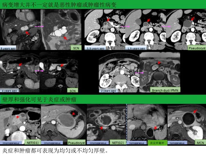 影像PPT - 【PPT】胰腺囊性病变影像学诊断要点与误区-6