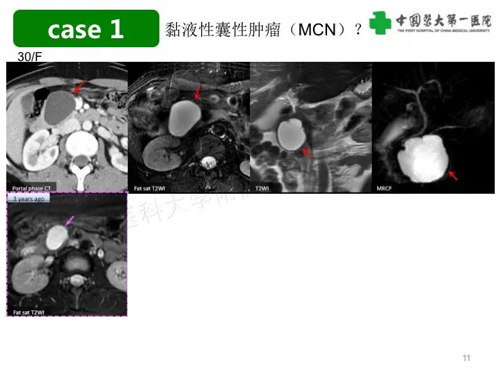 影像PPT - 【PPT】胰腺囊性病变影像学诊断要点与误区-11