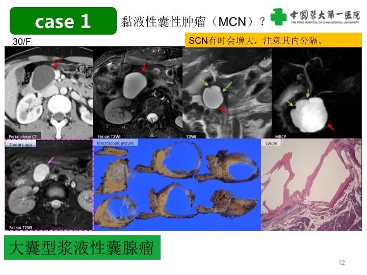 影像PPT - 【PPT】胰腺囊性病变影像学诊断要点与误区-12
