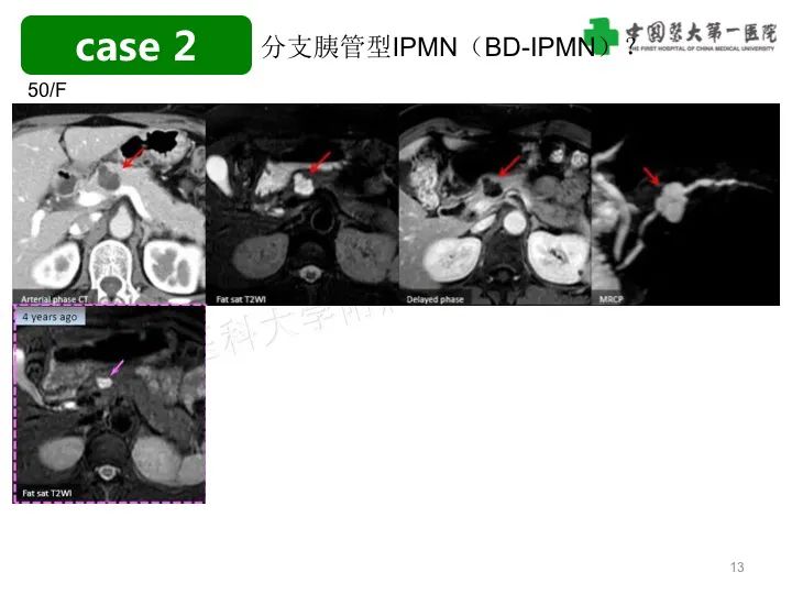 影像PPT - 【PPT】胰腺囊性病变影像学诊断要点与误区-13