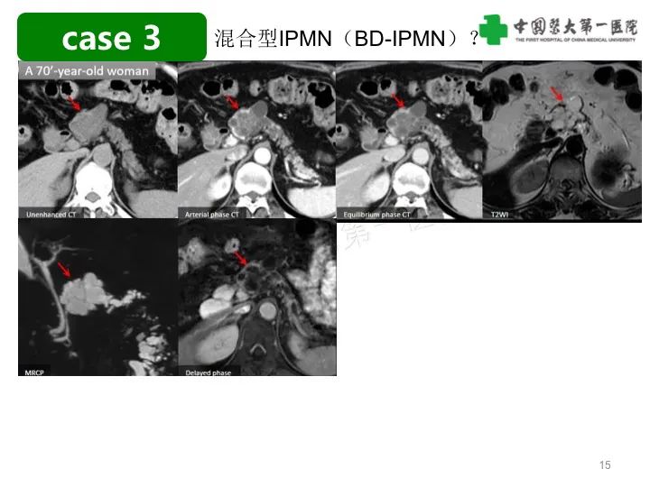 影像PPT - 【PPT】胰腺囊性病变影像学诊断要点与误区-15