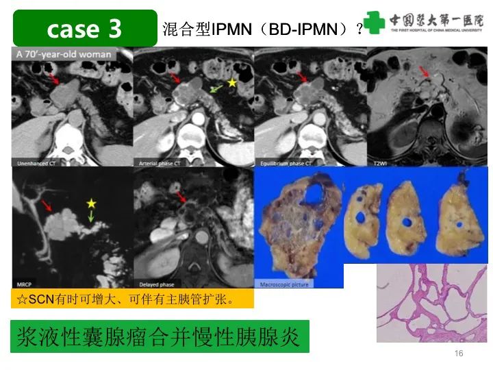 影像PPT - 【PPT】胰腺囊性病变影像学诊断要点与误区-16