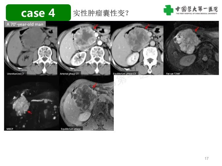 影像PPT - 【PPT】胰腺囊性病变影像学诊断要点与误区-17