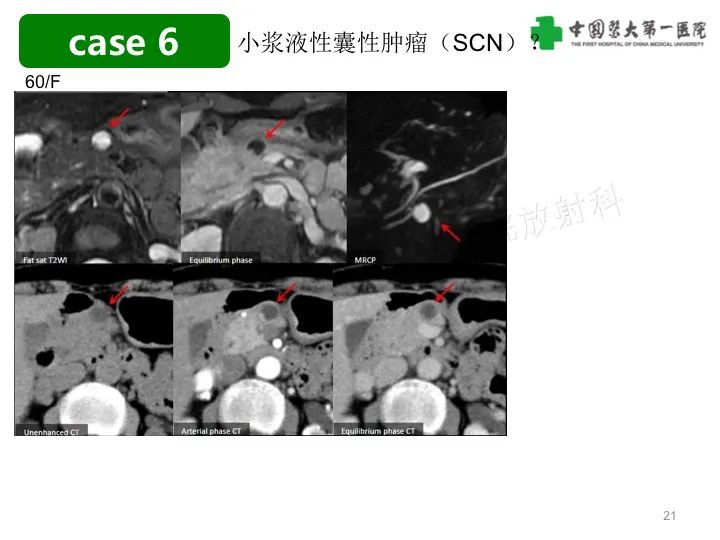 影像PPT - 【PPT】胰腺囊性病变影像学诊断要点与误区-21