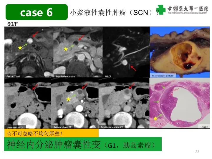 影像PPT - 【PPT】胰腺囊性病变影像学诊断要点与误区-22